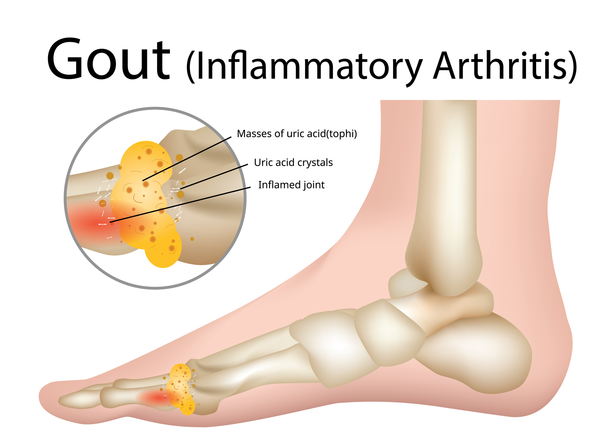 Gout Hereditary