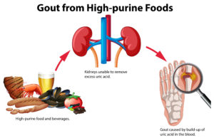 Gout from High-purine Foods illustration