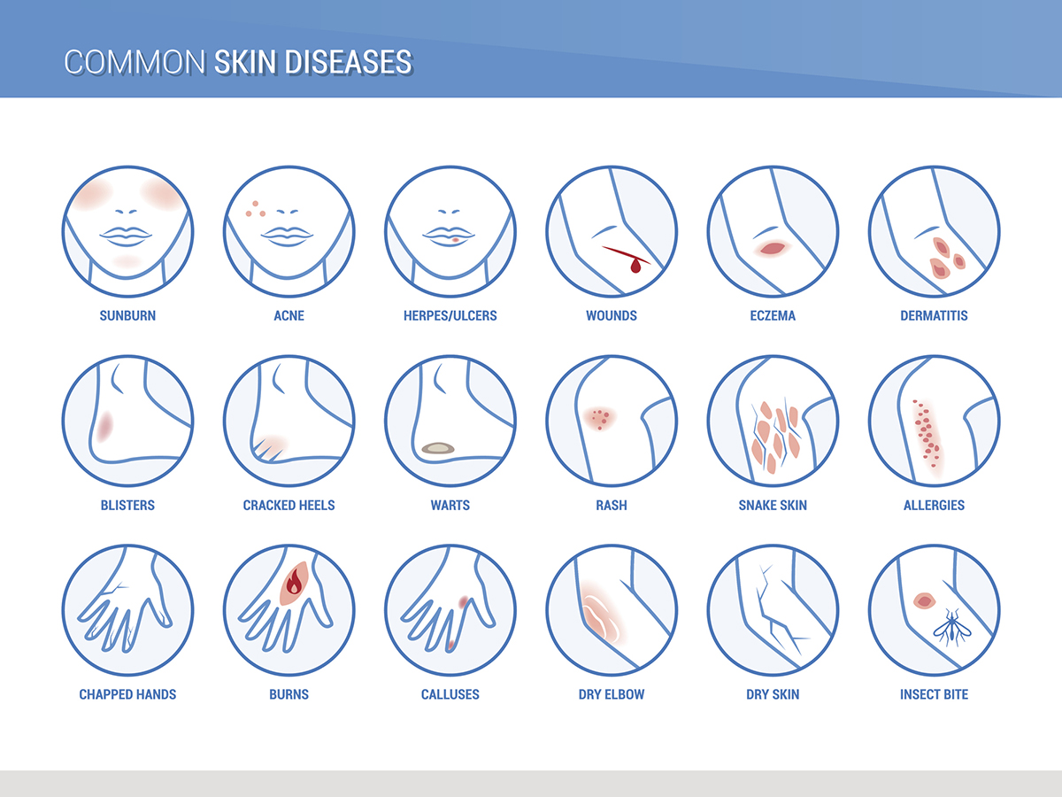 Skin diseases