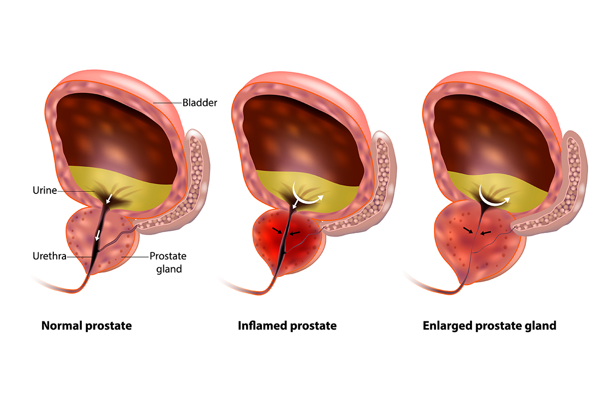 benign prostatic hyperplasia